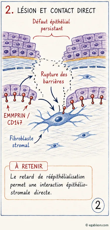 Schéma d'un défect épithélial persistant : rupture des barrières et contact direct entre épithélium et fibroblaste stromal exprimant EMMPRIN/CD147